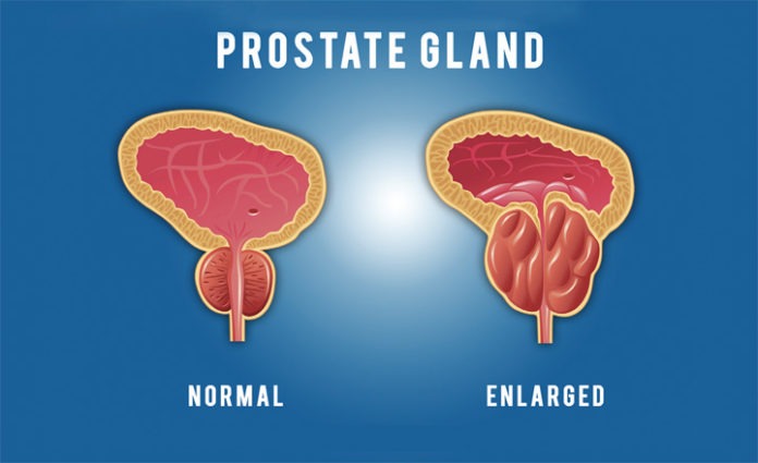 Prostate cancer benign prostatic hyperplasia Prostate cancer benign prostatic hyperplasia