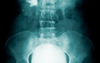 full bladder x-ray image before what is urodynamic testing