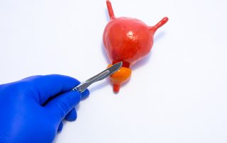 urologist holds scalpel in hand over anatomical model of bladder and prostate, discussing prostatectomy recovery tips